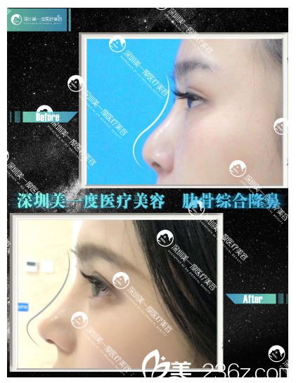 深圳美一度李晓平隆鼻多少钱？公布本院整形价格表及双眼皮隆鼻隆胸吸脂案例