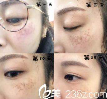 飞韩国童颜中心做的激光祛斑 飞韩国童颜中心做的激光祛斑