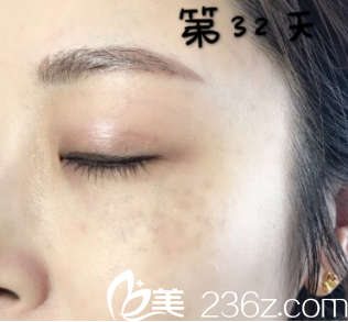 可能因为我的斑点颜色比较重吧