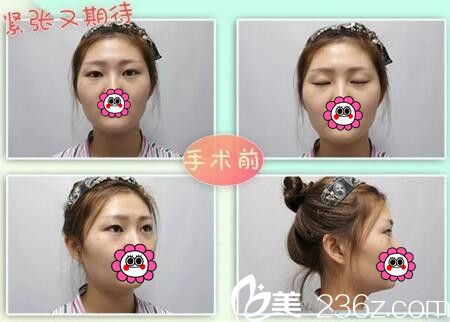 双眼皮面部填充术前照 双眼皮面部填充术前照