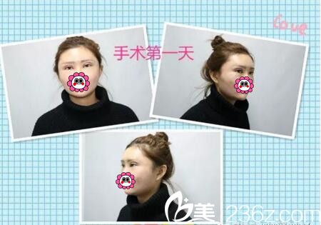 整形手术术后天 整形手术术后天