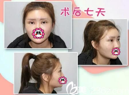 双眼皮填充术后一周 双眼皮填充术后一周