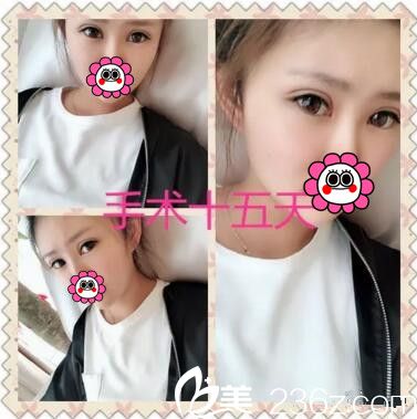 面部脂肪填充双眼皮术后半个月<span style= 面部脂肪填充双眼皮术后半个月<span style=