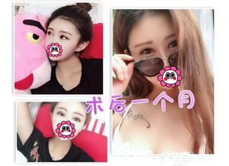 面部脂肪填充+双眼皮术后一个月<span style= 面部脂肪填充+双眼皮术后一个月<span style=