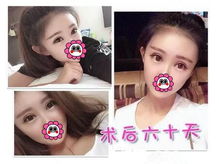 分享我在海南韩美做自体脂肪填充面部+眼综合术后两个月恢复效果图