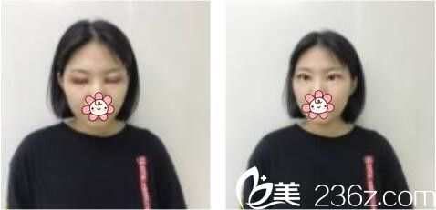 上海康奥医疗美容医院钱麟双眼皮真人案例术后第三天