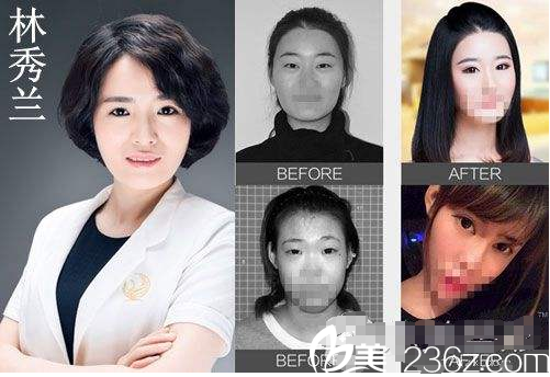 林秀兰医生眼部整形案例