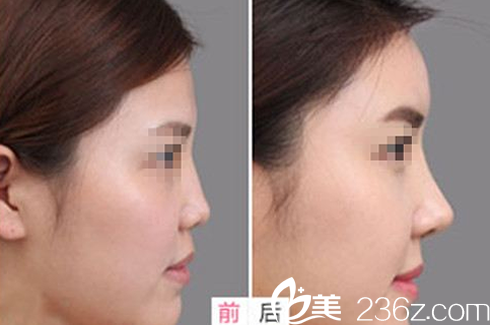 太原华美<!--<i data=20240703-sp></li>
<li><i data=20240703-sp></i>-->鼻综合术前术后效果对比