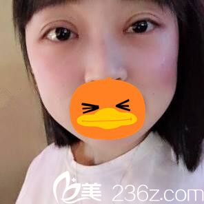 割双眼皮+开眼角术后20天恢复程度