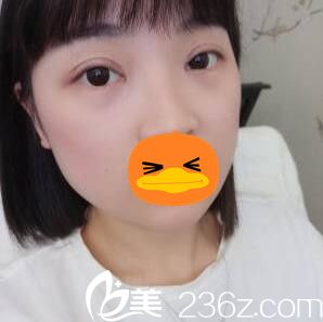 看我在整形医院做全切双眼皮+开眼角术后1个月恢复效果，我挺喜欢的！
