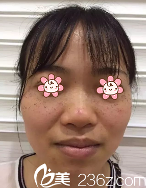 贵州利美康激光祛斑术后五天 贵州利美康激光祛斑术后五天