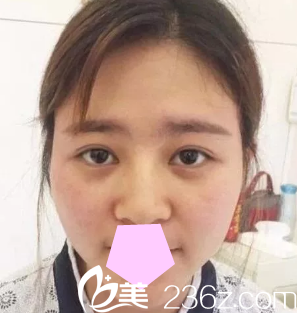 我在大同美神整形美容医院做鼻综合之前的照片 我在大同美神整形美容医院做鼻综合之前的照片