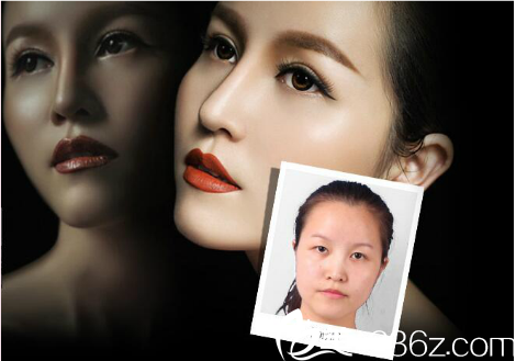 整形医院罗志敏隆鼻案例 整形医院罗志敏隆鼻案例