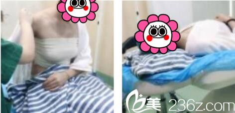 上海康奥医疗美容医院钱麟假体隆胸真人案例术后第三天