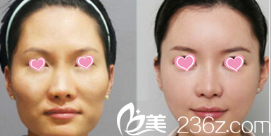 北京圣嘉荣黄大勇面部脂肪填充<span style= 北京圣嘉荣黄大勇面部脂肪填充<span style=