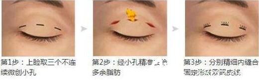 潜江蓝鸟韩式双眼皮的手术过程