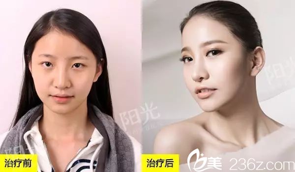 <!--<i data=20240703-sp></i>-->整形医院双眼皮隆鼻案例效果图 <!--<i data=20240703-sp></i>-->整形医院双眼皮隆鼻案例效果图