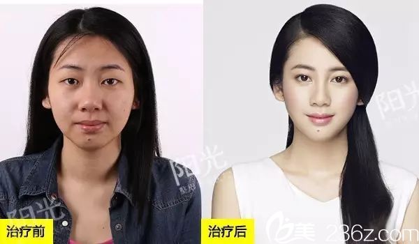 <!--<i data=20240703-sp></i>-->整形医院双眼皮整形案例图 <!--<i data=20240703-sp></i>-->整形医院双眼皮整形案例图