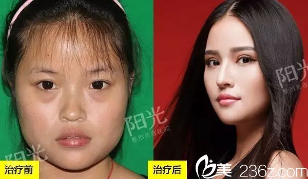 <!--<i data=20240703-sp></i>-->整形医院双眼皮隆鼻和下颌角整形案例图 <!--<i data=20240703-sp></i>-->整形医院双眼皮隆鼻和下颌角整形案例图