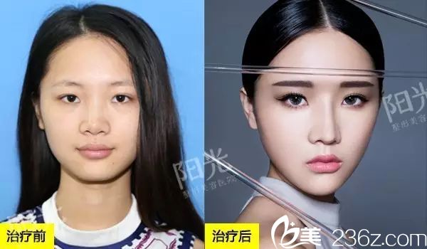 <!--<i data=20240703-sp></i>-->整形医院隆鼻和自体脂肪全脸填充案例图 <!--<i data=20240703-sp></i>-->整形医院隆鼻和自体脂肪全脸填充案例图