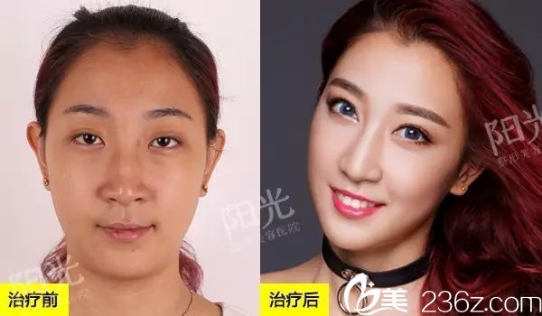 <!--<i data=20240703-sp></i>-->整形医院双眼皮隆鼻案例对比图 <!--<i data=20240703-sp></i>-->整形医院双眼皮隆鼻案例对比图