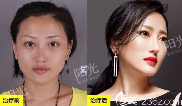 <!--<i data=20240703-sp></i>-->整形医院双眼皮和脂肪填充效果图 <!--<i data=20240703-sp></i>-->整形医院双眼皮和脂肪填充效果图