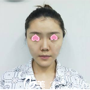 <!--<i data=20240703-sp></i>-->医院面部脂肪填充案例术前照 <!--<i data=20240703-sp></i>-->医院面部脂肪填充案例术前照