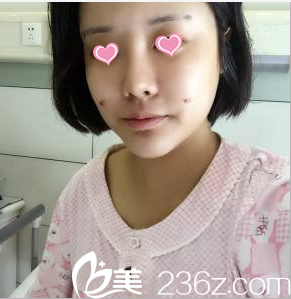 金秋燕面部脂肪填充案例术后4天样子 金秋燕面部脂肪填充案例术后4天样子