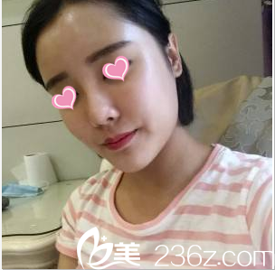 <!--<i data=20240703-sp></i>-->自体脂肪面部填充案例术后第28天效果 <!--<i data=20240703-sp></i>-->自体脂肪面部填充案例术后第28天效果