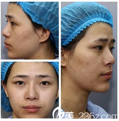 来<!--<i data=20240703-sp></i>-->整形医院做超皮秒祛斑前的照片 来<!--<i data=20240703-sp></i>-->整形医院做超皮秒祛斑前的照片