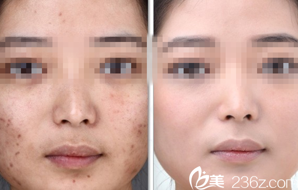 祛痘对比图