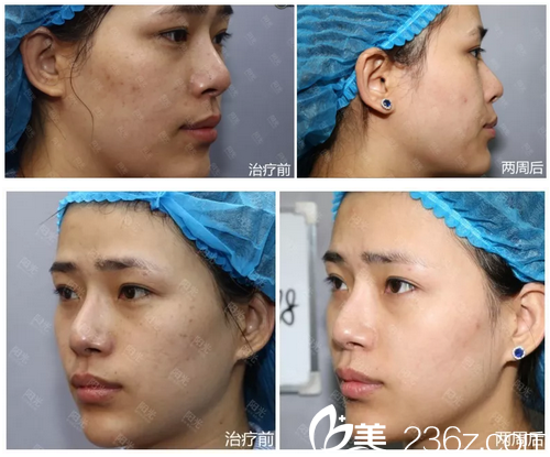 <!--<i data=20240703-sp></i>-->整形医院超皮秒祛两周效果对比图 <!--<i data=20240703-sp></i>-->整形医院超皮秒祛两周效果对比图