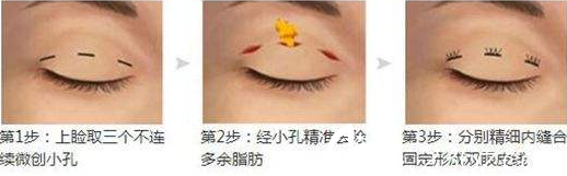 潜江市蓝鸟韩式双眼皮的手术方法