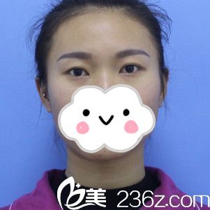 赣州华美双眼皮手术案例 赣州华美双眼皮手术案例