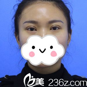 赵亚均医生双眼皮手术案例分享