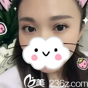 双眼皮手术后20天 双眼皮手术后20天