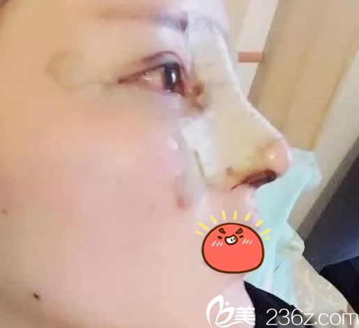 在绍兴华美刚做完隆鼻手术照片