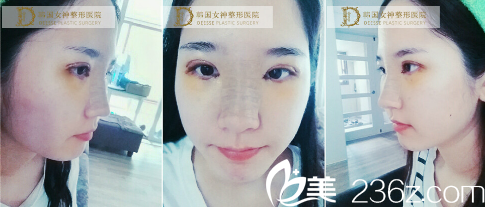 终于我在韩国女神医院做了手术，让我的眼鼻更<span style=