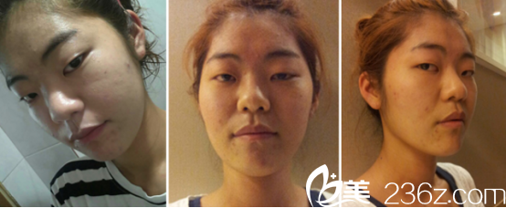 韩国延世整形医院双眼皮双眼皮+假体隆鼻术前照片,看我呆滞的样子 韩国延世整形医院双眼皮双眼皮+假体隆鼻术前照片,看我呆滞的样子