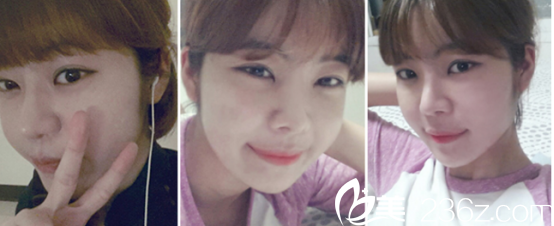 这是恢复了一个月后的样子 这是恢复了一个月后的样子