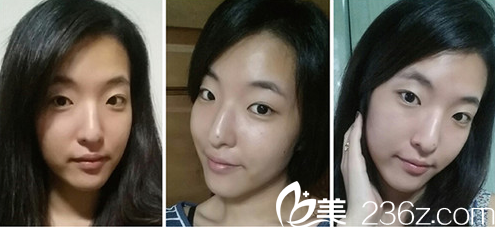 韩国枓翰整形医院全切双眼皮+鼻综合案例