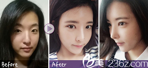 一个月后朋友说我的鼻子像一个明星，我也不怎么看美剧