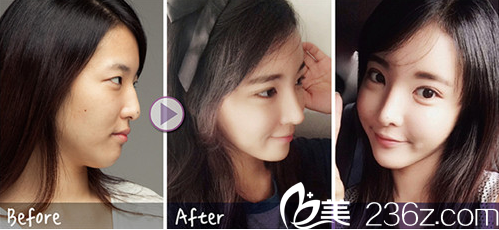 整容后的我真的年轻了好多岁啊 整容后的我真的年轻了好多岁啊