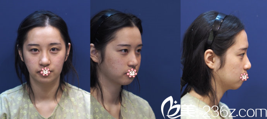 去韩国KIWI整形外科面诊的我 去韩国KIWI整形外科面诊的我