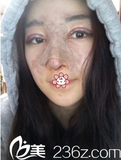 金智勋双眼皮假体隆鼻术后6天 金智勋双眼皮假体隆鼻术后6天