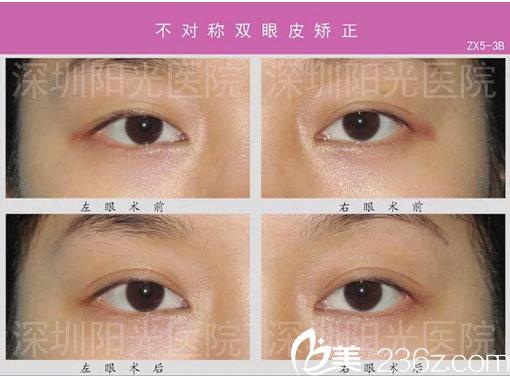 <!--<i data=20240703-sp></i>-->整形医院双眼皮不对称失败修复案例 <!--<i data=20240703-sp></i>-->整形医院双眼皮不对称失败修复案例