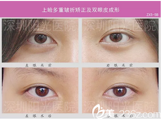 <!--<i data=20240703-sp></i>-->整形医院多层双眼皮失败修复案例 <!--<i data=20240703-sp></i>-->整形医院多层双眼皮失败修复案例