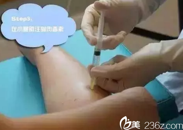 注射瘦腿过程