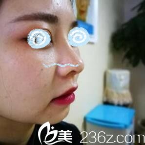 假体隆鼻第八天效果 假体隆鼻第八天效果