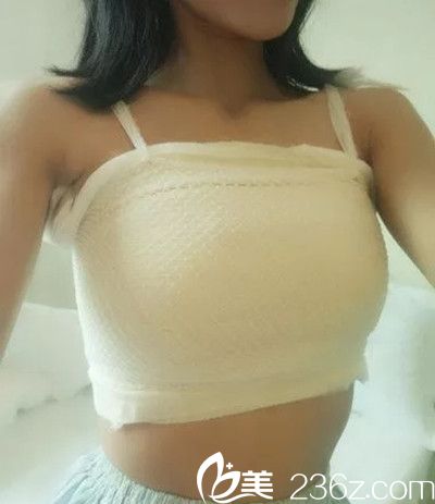 张维华医生假体隆胸手术案例 张维华医生假体隆胸手术案例